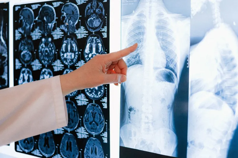 Silent Erosion: How Prednisone Quietly Weakens Your Bones and the Calcium Strategy That Can Fight Back